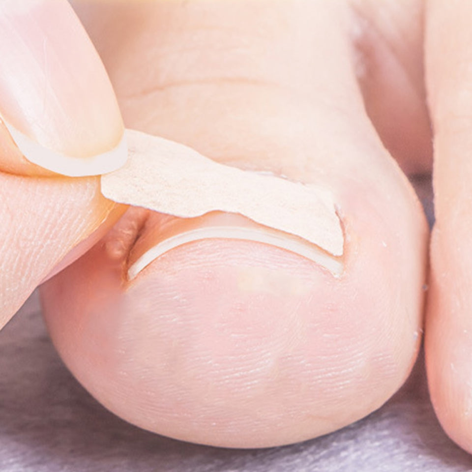 Ingrown Toenail Corrector Patches