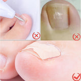 Ingrown Toenail Corrector Patches